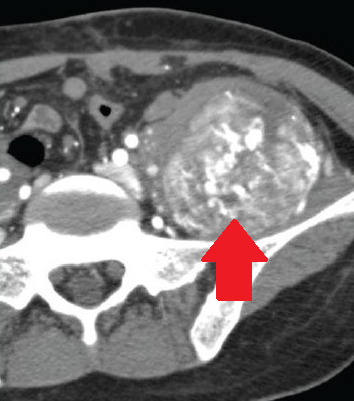RETROPERITONEAL ANGIOSARCOMA
