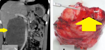 RETROPERITONEAL TUMOR INVOLVING IVC