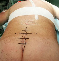 POSTERIOR APPROACH