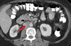 RETROPERITONEAL FIBROSIS - DILATED URETER