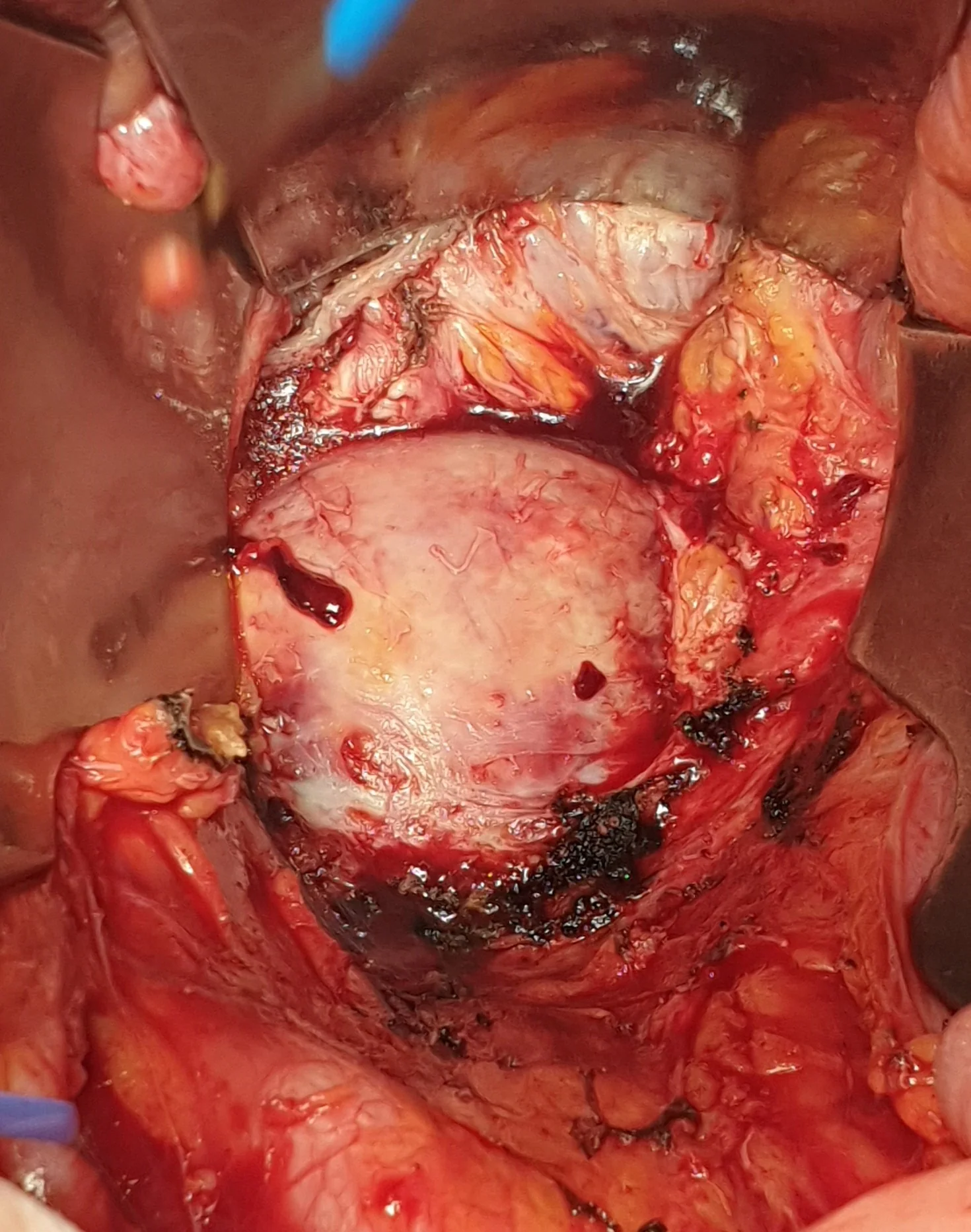 CHORDOMA
