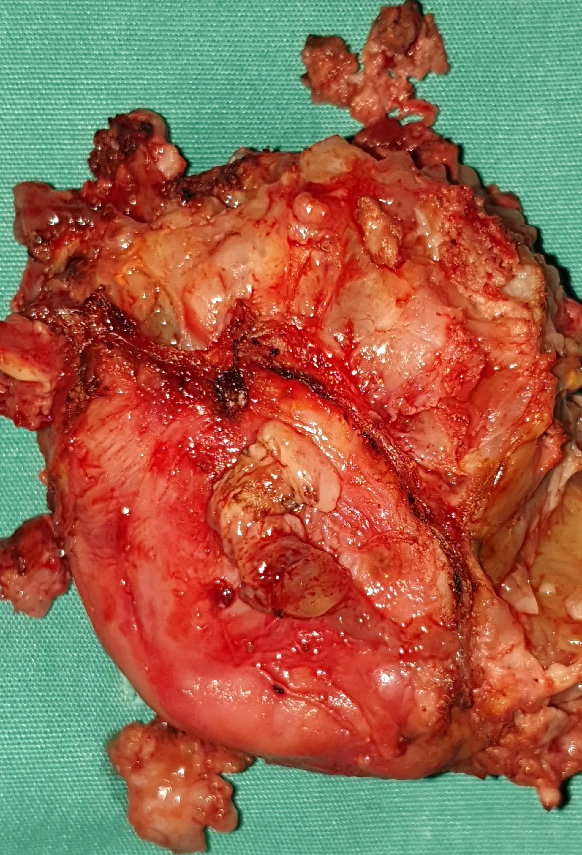 CHORDOMA