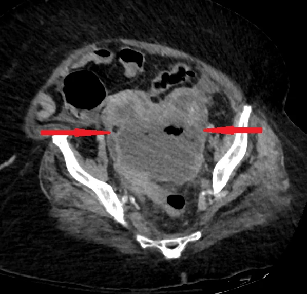 EPITHELIOID PELVIC SARCOMA