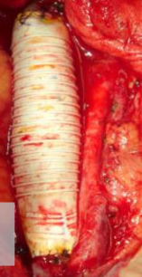 IVC REPLACEMENT