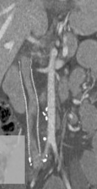 IVC REPLACEMENT