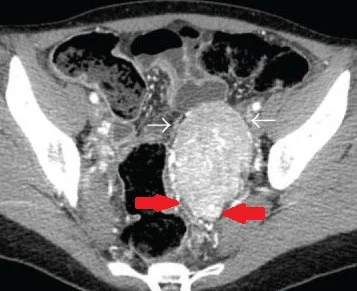 LARGE PELVIC EXTRA-ADRENAL SYMPATHETIC PARAGANGLIOMA 1