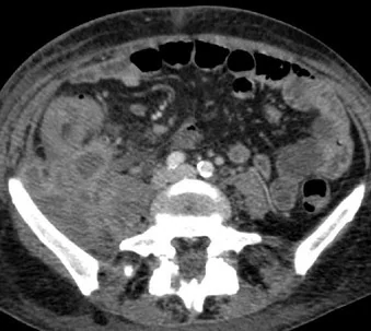PELVIC ACTINOMYCOSIS 