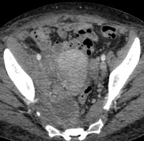 PELVIC ACTINOMYCOSIS