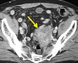 PELVIC AMYLOIDOMA