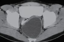 PRESACRAL CYSTIC TERATOMA