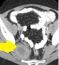 PRESACRAL EWING'S SARCOMA