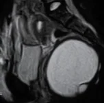 PRESACRAL HAMARTOMA