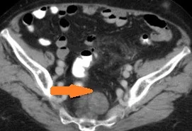PRESACRAL MYELOLIPOMA 