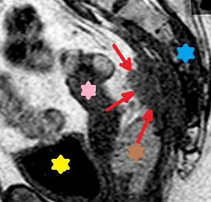 PRESACRAL NEUROENDOCRINE CARCINOMA 