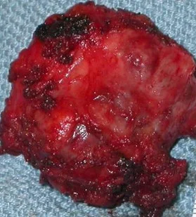 PRESACRAL NEUROENDOCRINE CARCINOMA