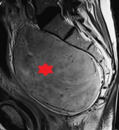 PRESACRAL SCHWANNOMA 