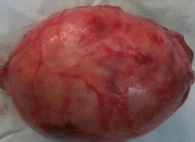 PRESACRAL SCHWANNOMA 