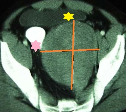PRESACRAL SCHWANNOMA 