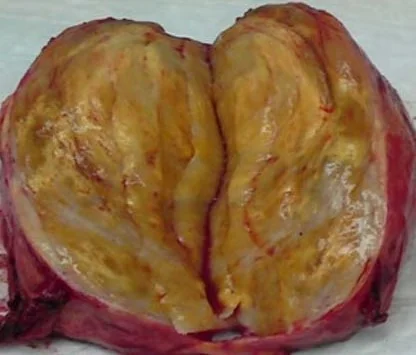 PRESACRAL SCHWANNOMA 