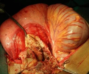 PRESACRAL SCHWANNOMA