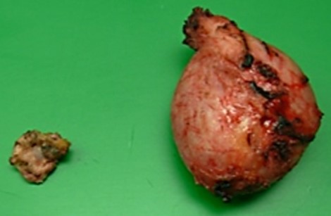 PRESACRAL TAILGUT CYST 