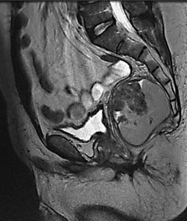 PRESACRAL TERATOCARCINOMA
