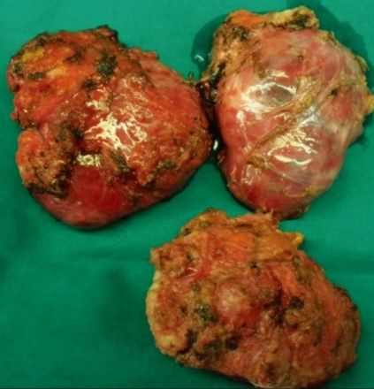 PRESACRAL TERATOMAS