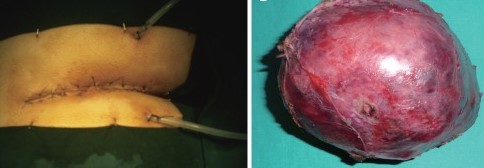 PRESACRAL TUMOR