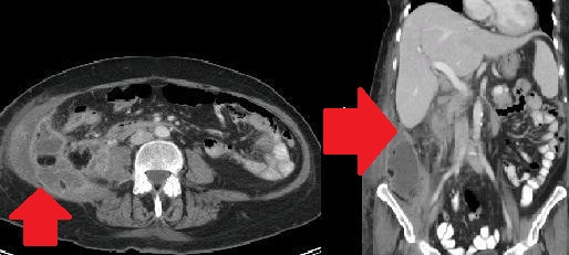 RETROPERITONEAL ABSCESS