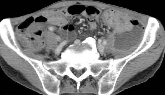 RETROPERITONEAL ABSCESS