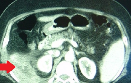 RETROPERITONEAL ABSCESS