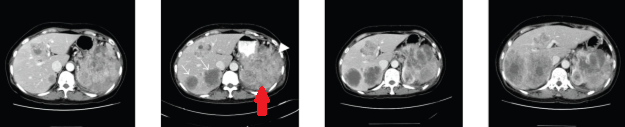 RETROPERITONEAL ANGIOSARCOMA