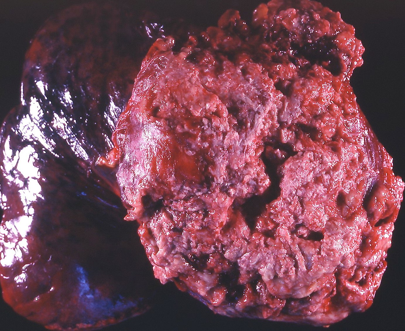 RETROPERITONEAL ANGIOSARCOMA