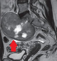 RETROPERITONEAL BENIGH SCHWANNOMA