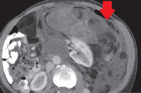 RETROPERITONEAL DEDIFFERENTIATED LIPOSARCOMA