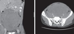 RETROPERITONEAL DESMOID TUMOR