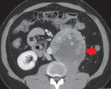 RETROPERITONEAL EWING'S SARCOMA