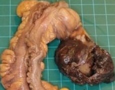 RETROPERITONEAL EXTRAOVARIAN FIBROTHECOMA 