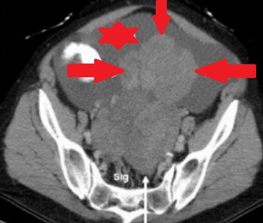 RETROPERITONEAL EXTRAOVARIAN THECOMA