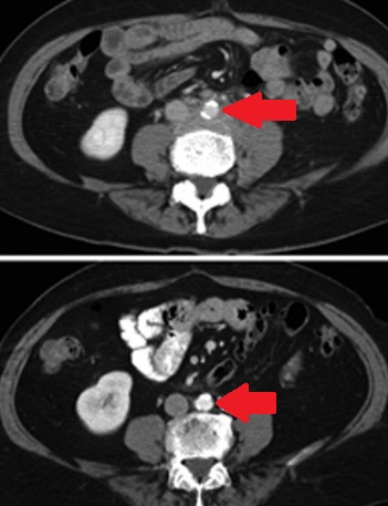 RETROPERITONEAL FIBROSIS-BEFORE AND AFTER TREATMENT