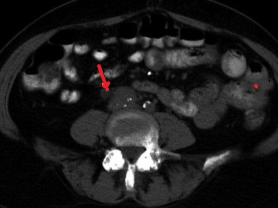 RETROPERITONEAL FIBROSIS - DILATED URETER