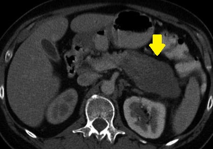 RETROPERITONEAL FIBROSIS INVOLVING THE TAIL OF  PANCREAS