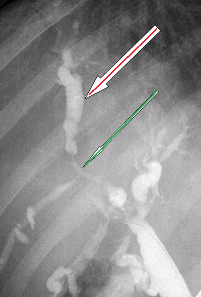 RETROPERITONEAL FIBROSIS+SCLEROSING CHOLANGITIS 