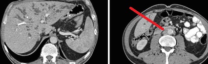 RETROPERITONEAL FIBROSIS+SCLEROSING PERITONITIS 
