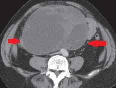 RETROPERITONEAL GIST 