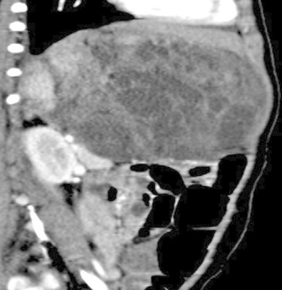 RETROPERITONEAL IMMATURE TERATOMA 