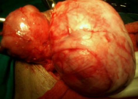 RETROPERITONEAL LEIOMYOMA 