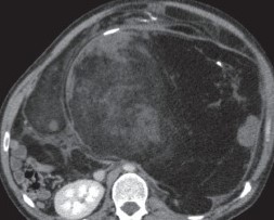 RETROPERITONEAL LIPOSARCOMA