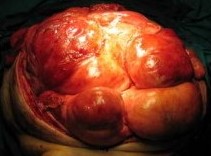 RETROPERITONEAL LIPOSARCOMA