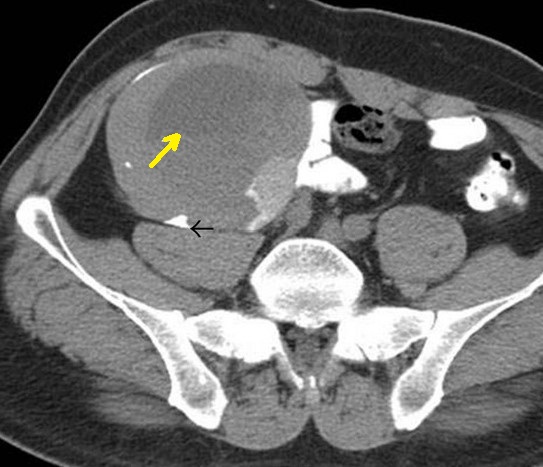RETROPERITONEAL MALIGNANT HISTIOCYTOMA